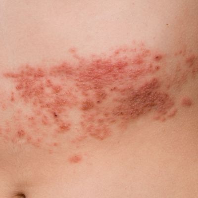 Herpes tình dục