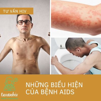 Những biểu hiện khi tiến tới AIDS