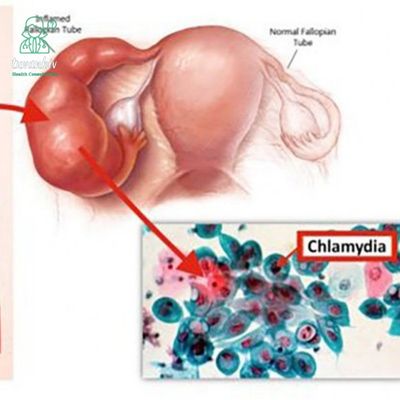 Bệnh Chlamydia