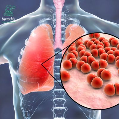 Viêm phổi do nhiễm Pneumocystis